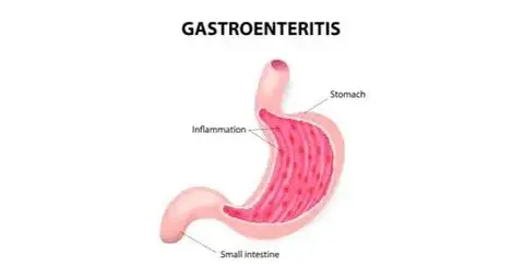 See a Doctor for Gastroenteritis